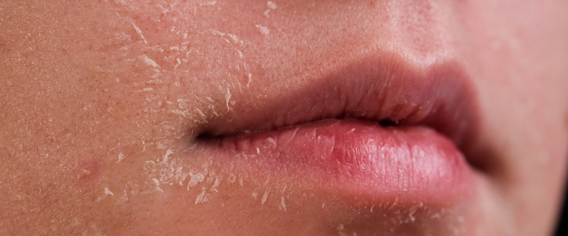 Dry Skin: Everything You Need to Know