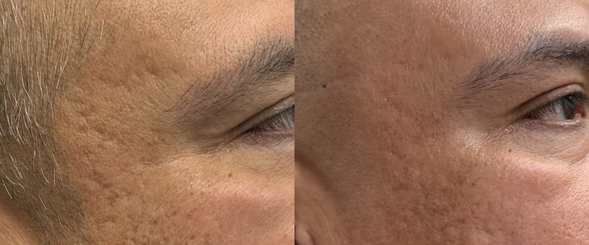 Skinsation LA – Skin Tightening, Botox & Lip Fillers in Los Angeles
