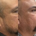 Skinsation LA – Skin Tightening, Botox & Lip Fillers in Los Angeles