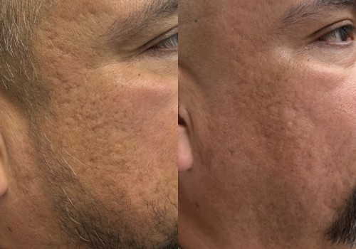Skinsation LA – Skin Tightening, Botox & Lip Fillers in Los Angeles